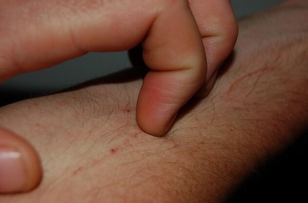 parazit varlığının bir belirtisi olarak kaşıntılı cilt